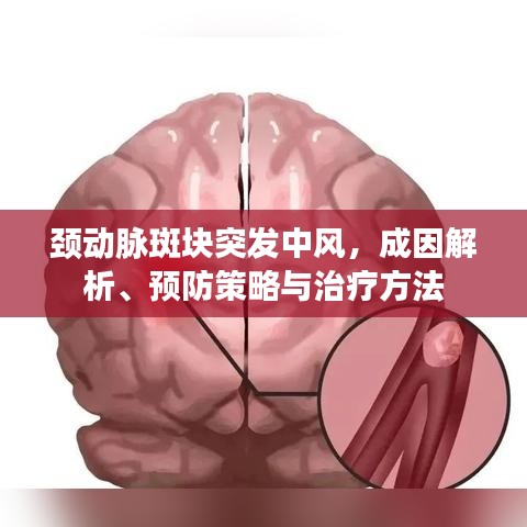 頸動脈斑塊突發(fā)中風(fēng)，成因解析、預(yù)防策略與治療方法